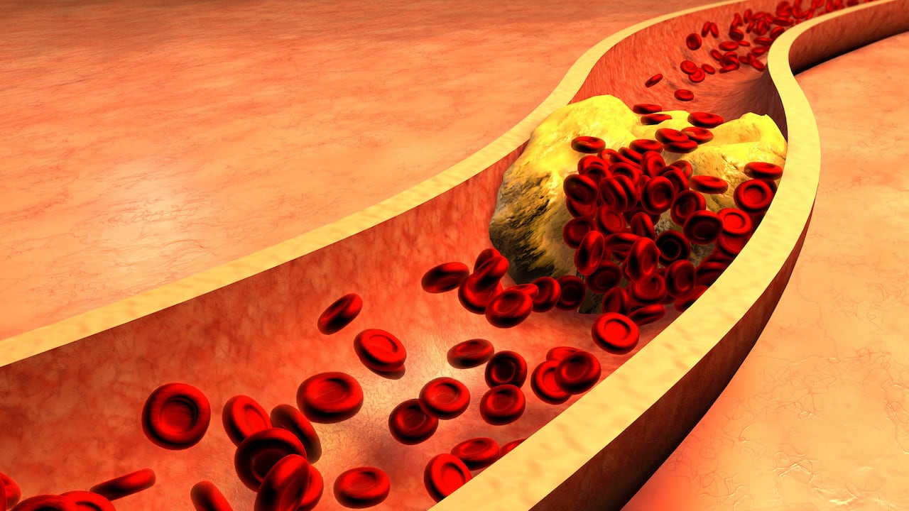 Diabetes y colesterol elevado podrían multiplicar el riesgo de Alzheimer y Parkinson